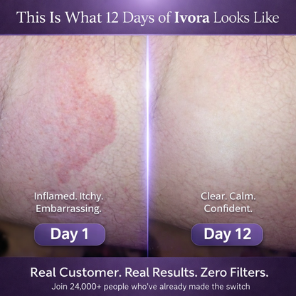 Ivora™ Antifungal Soap
